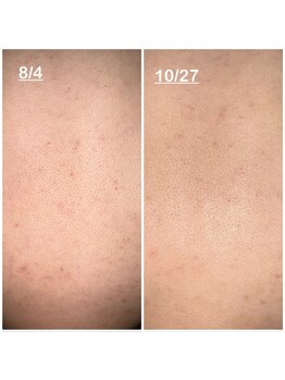 ミニョン(mignon)/モニター結果