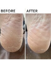 クオッカ(Quokka)/角質ケア