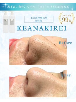 リアム(LiAm)/毛穴洗浄