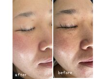 ラニア(Lania)/シリカトリートメント