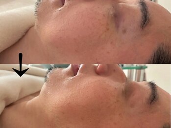 サロン ドロップ 上小田井(Salon drop)/「シミ改善」途中経過