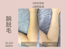 アルゴ 山口宇部店(ALGO)/ショット数4倍で効果抜群！
