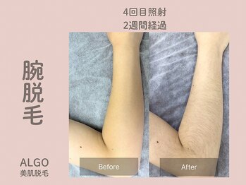 アルゴ 山口宇部店(ALGO)/ショット数4倍で効果抜群!