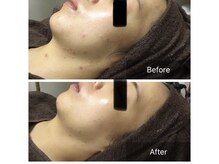 リラーナ(Re rana)/大人ニキビケア♪