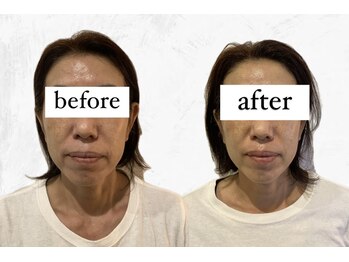 ビーアイリー(Be irie)/フェイシャルエステ直後の変化