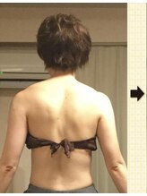 ノットノット 自由が丘(Not Knot)/１.ブライダル 上半身集中施術前