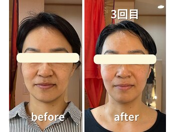 カルナー 武蔵小杉/ツヤ肌トーンとリフトアップ