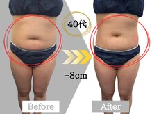 ジャパ(JAPA)/今話題の脂肪冷却☆