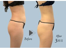 スクエア サロン(Square Salon)/【温活×痩身】Wデトックス130分