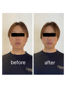 リバイブ 五反田店(REVIVE)/小顔矯正1回