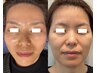 【臍帯・羊膜幹細胞フェイシャルエステ】たるみ集中リフトアップ