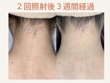 フロレゾン(Floraison)/うなじ脱毛 経過