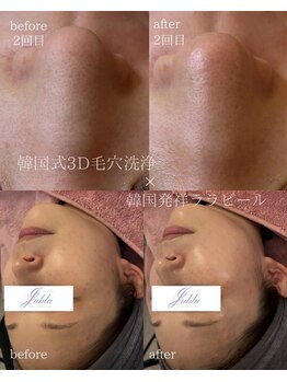 ユフラ(Juhla)/韓国3D毛穴洗浄+ララピール