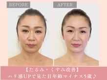 サロン ド リアン(salon de lien)/【たるみ・くすみ改善】ハリ感UP