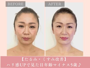 サロン ド リアン(salon de lien)/【たるみ・くすみ改善】ハリ感UP