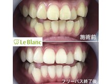 ルブラン 奈良店(Le Blanc)/春に向けてホワイトニング！
