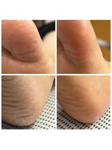 ドクターネイル爪革命 十条店/角質ケア