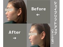 脱毛 フェイシャルサロン ケア(CARE)/［シェイプリフトUP：2］術後