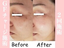 ラクワン(R coin)/GFチャージ