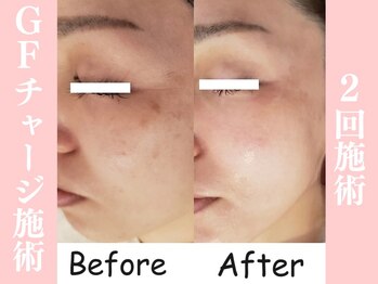 ラクワン(R coin)/GFチャージ