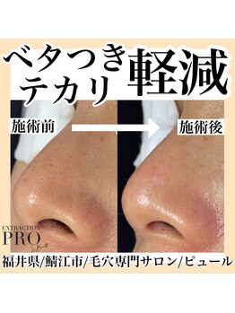 ピュール 鯖江店(PUR)/毛穴サロン/毛穴ケア/毛穴洗浄