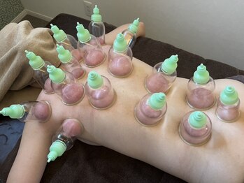ジプソ(gypso)の写真/【カッピング×全身かっさ】ガチガチに固まった頑固なコリに徹底アタック！どれだけ濃い色の跡がつくか！？