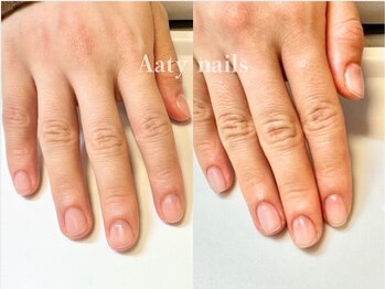 アーティネイルズ(Aaty Nails)/【深爪矯正】ハンド