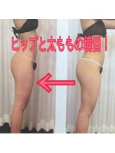 ボディエステティック アクアオーラ 富山店/ヒップと太ももの境目