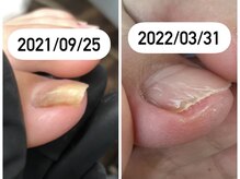 エスネイル(S Nail)/巻き爪ケア/巻き爪補正