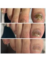 ドクターネイル爪革命 十条店/肥厚爪ケア