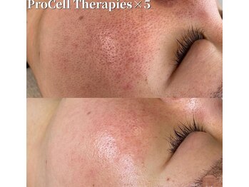 アトリア(ATRIA)/プロセルフェイシャル