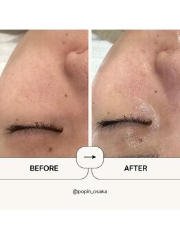 ポピン(POPIN)/アクアピール×白玉酸素管理1回