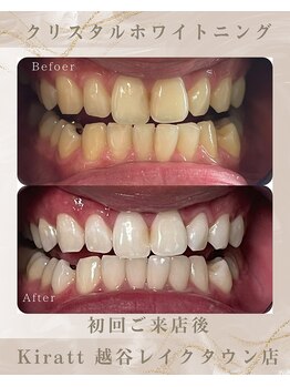 キラット 越谷レイクタウン店(Kiratt)/ビフォーアフター　10