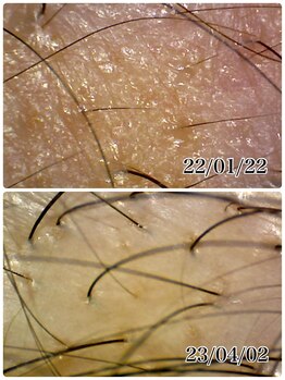 ミルラ(myrrh)/頭皮にヒト幹細胞培養液の栄養を