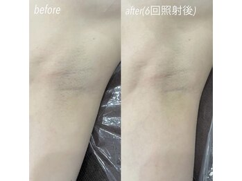 ハイリー(Hily)/脇 before、after