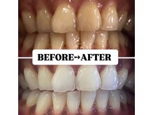 ホワイトニングサロン 豊中/Before&After美白ホワイトニング