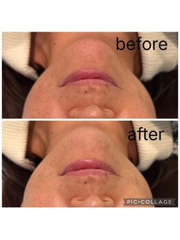 レイモード(Ray mode)/BBLフェイシャル&パック