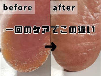 フットファースト 浜松天竜川店/角質ケアで一発改善！