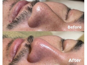 トム(Thom)/毛穴汚れごっそりメニューはコレ