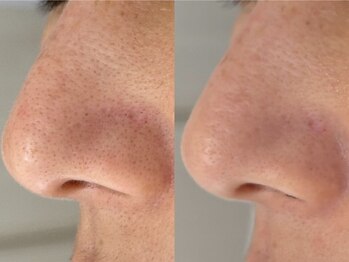 アンド ユー(and.yu)の写真/毛穴詰まり・たるみケアに!フォトで毛穴を引き締め、透明感あふれる肌へ♪