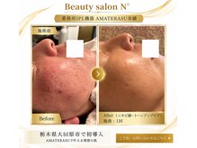 ナンバー(N°)の雰囲気（肌荒れ跡・トーンアップケア￥15000→11900）