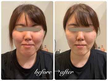 パルティール(PARTIR)/小顔マシン利用♪