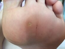 ビサンテ サロン/魚の目で悩みの方に人気,ケア前