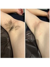 ブリッシュ(Bullish)/ワキ（ビフォーアフター）