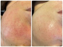 エスサロン(S.salon)の雰囲気（特許取得のハーブピーリングでニキビケア・赤ら顔に◎）