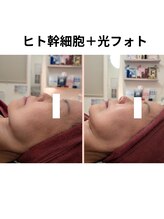 ワイズ(Y's)/ヒト幹細胞＋光フォト