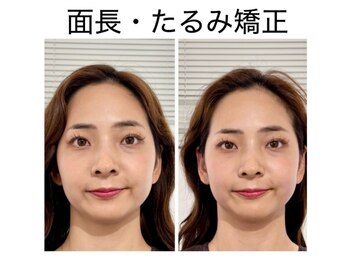 エレヴィザ トウキョウ 恵比寿院(ELVISA TOKYO)/面長・たるみ改善 / 初回施術