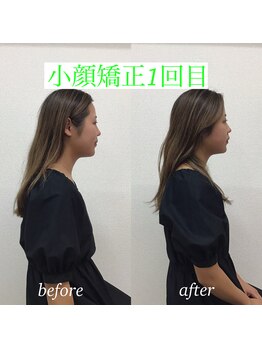 オズ六本木/六本木の姿勢も良くなる小顔矯正