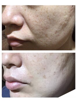 エヴァーグレース 河原町店/京都河原町の毛穴改善美肌サロン