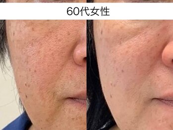 シミケア専門店 SAKURA 平塚店/平塚シミケア/伊勢店シミケア